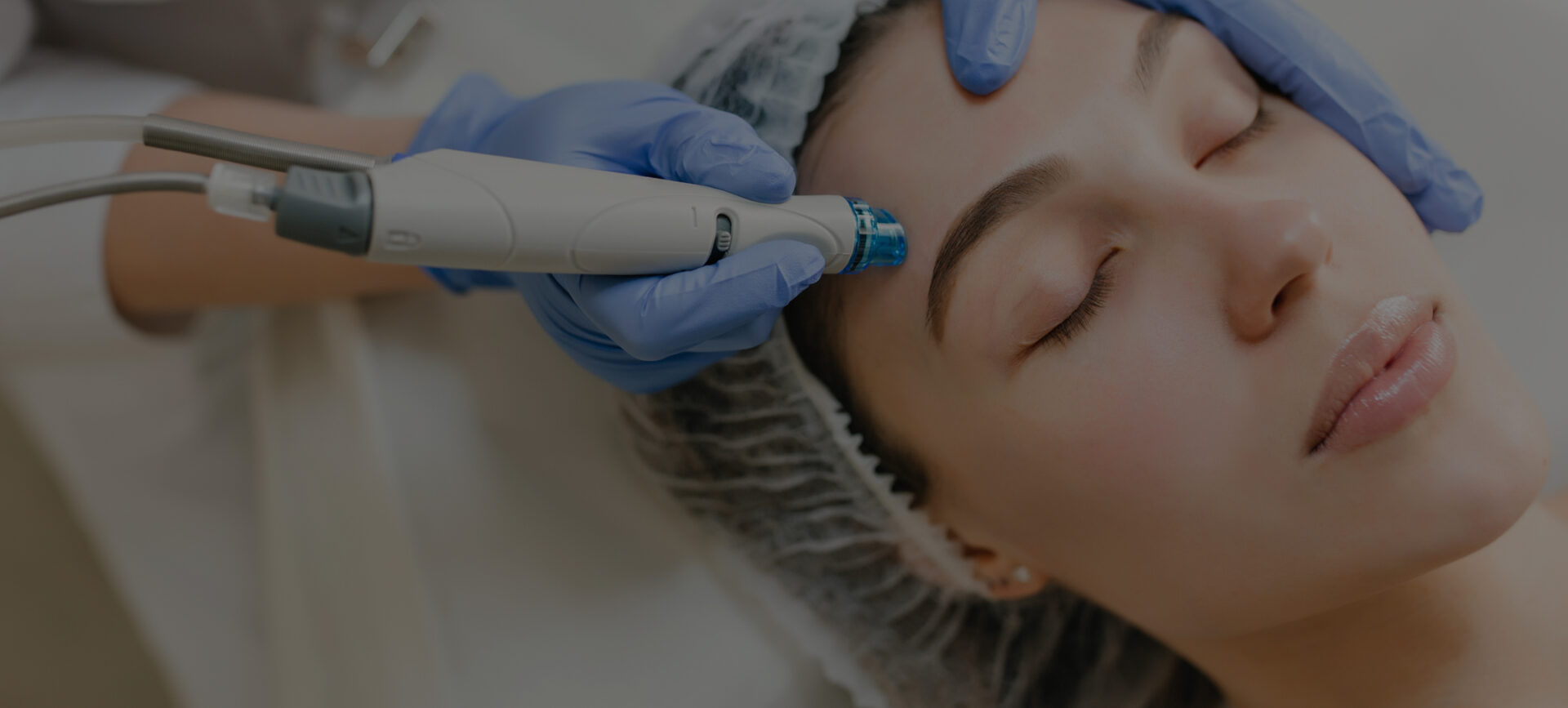 microneedling