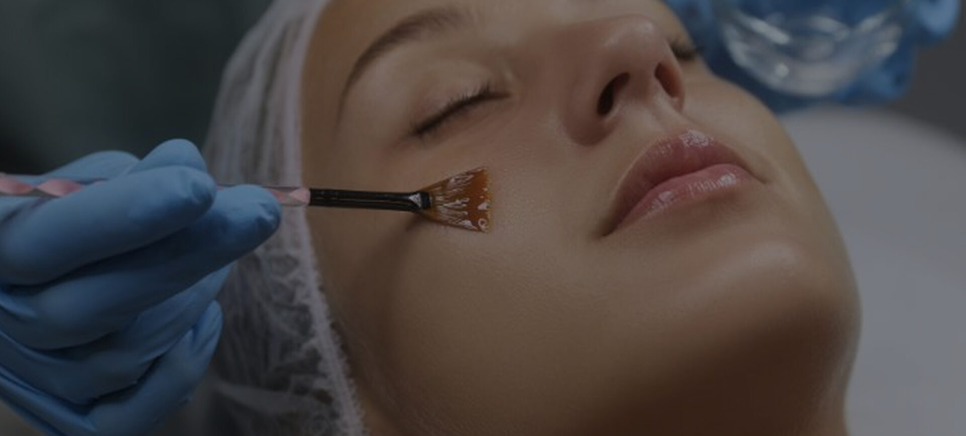 chemical peel